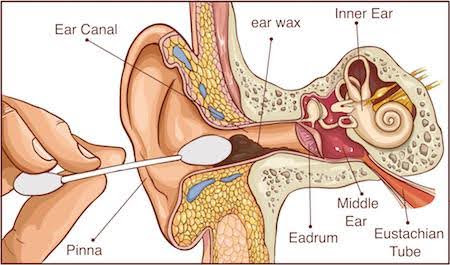 Common Ear Wax Issues and When to Seek Medical Attention